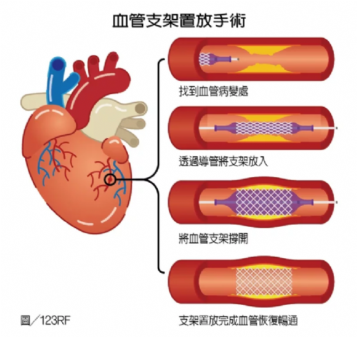 急性心肌梗塞猝死率高 3種血管支架如何選